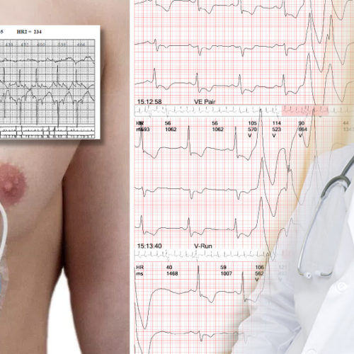 Cardiac Stress Test