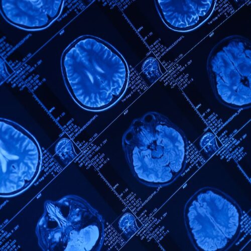 What Is Functional MRI?