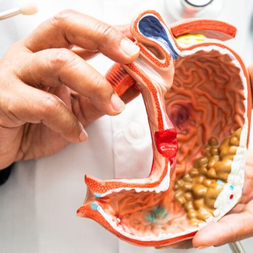 What Is an ERCP (Endoscopic Retrograde Cholangiopancreatography)?