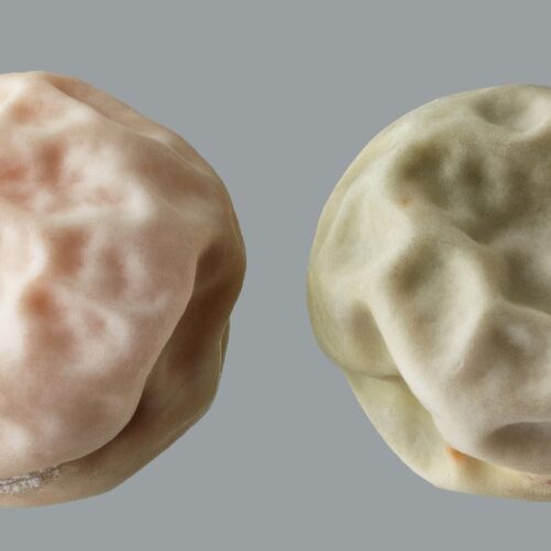 Cyst vs Tumor: Main Differences